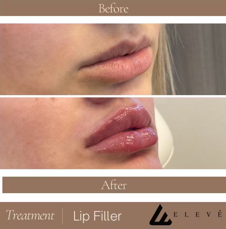 Injectables Before & After Gallery - Patient 726086 - Image 1