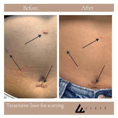 Eleve Glow Before & After Gallery - Patient 253941 - Image 1