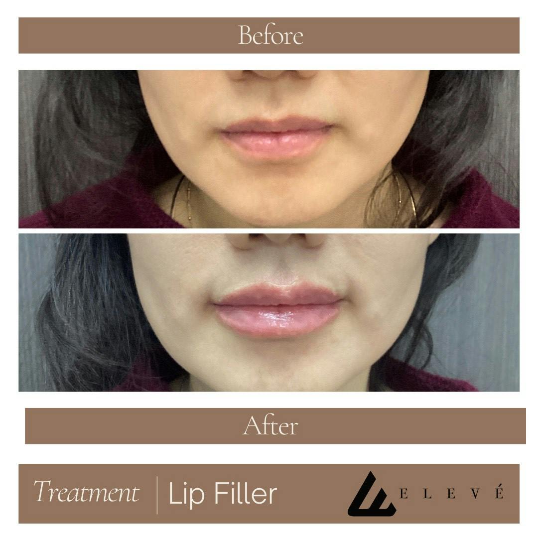 Injectables Before & After Gallery - Patient 394313 - Image 1