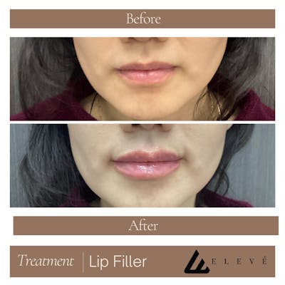 Injectables Before & After Gallery - Patient 394313 - Image 1