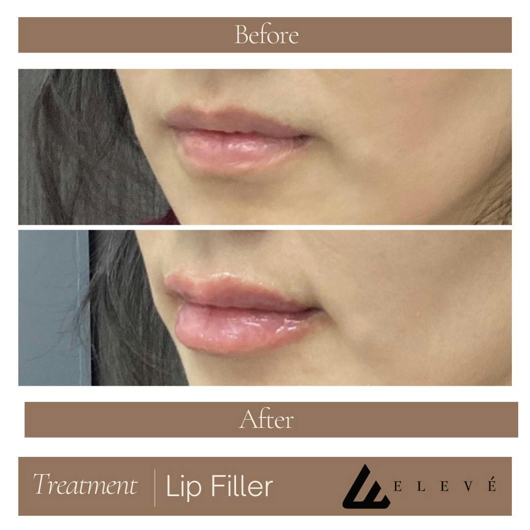 Injectables Before & After Gallery - Patient 344858 - Image 1