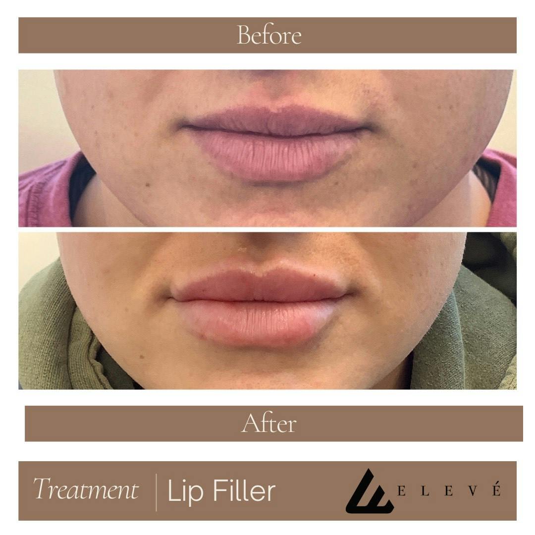 Injectables Before & After Gallery - Patient 294003 - Image 1