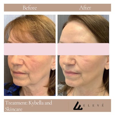 Skincare Before & After Gallery - Patient 521617 - Image 1