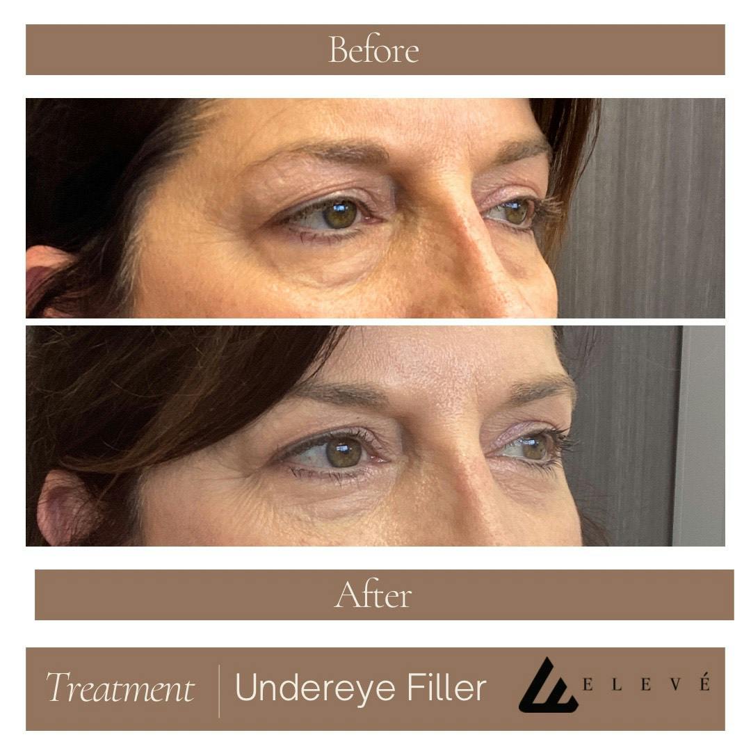 Injectables Before & After Gallery - Patient 279876 - Image 2