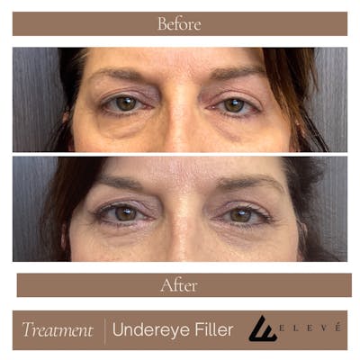 Injectables Before & After Gallery - Patient 279876 - Image 1