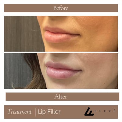 Injectables Before & After Gallery - Patient 421709 - Image 1