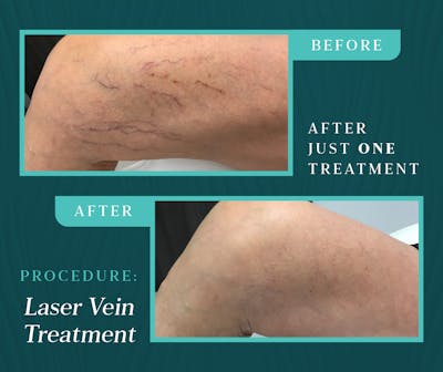 Laser Vein Treatment Before & After Gallery - Patient 413320 - Image 1