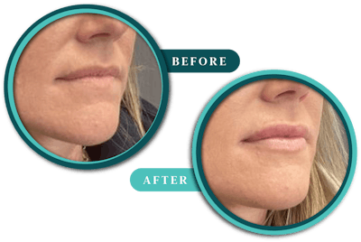 Injectables Before & After Gallery - Patient 421605 - Image 1