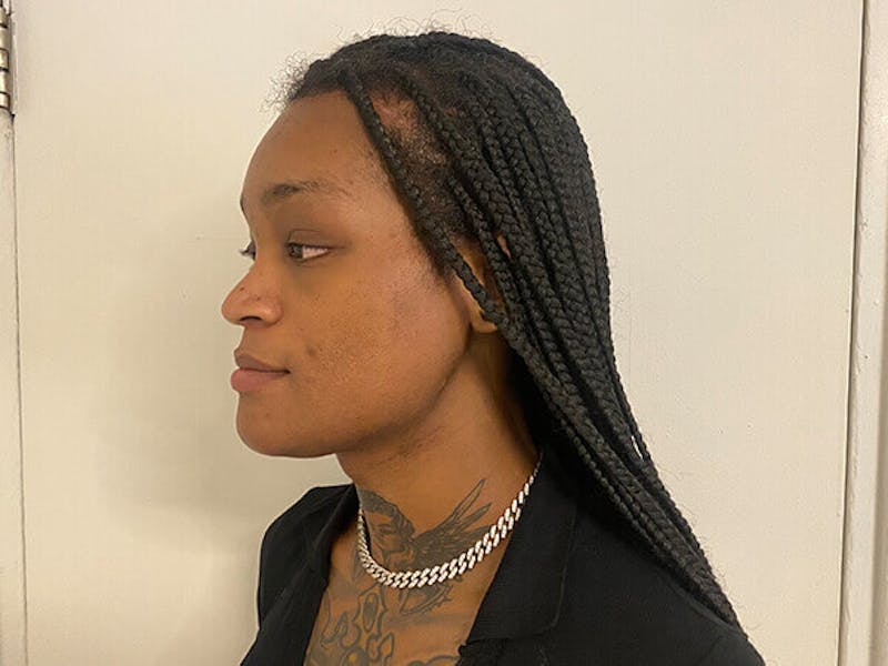 Case Studies Before & After Gallery - Patient 212472 - Image 4