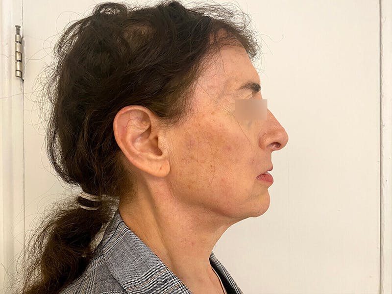 Case Studies Before & After Gallery - Patient 197338 - Image 1