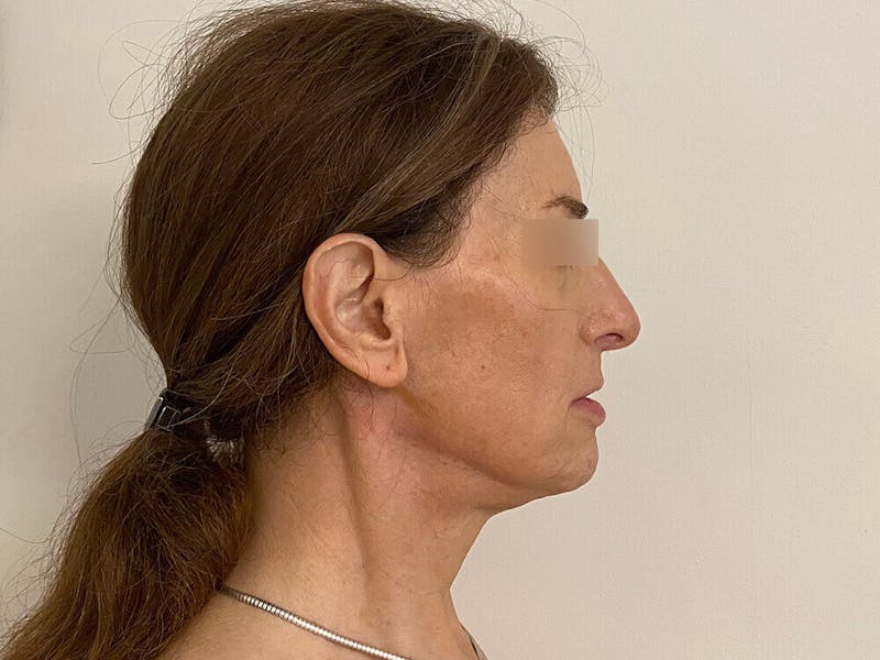 Case Studies Before & After Gallery - Patient 197338 - Image 2