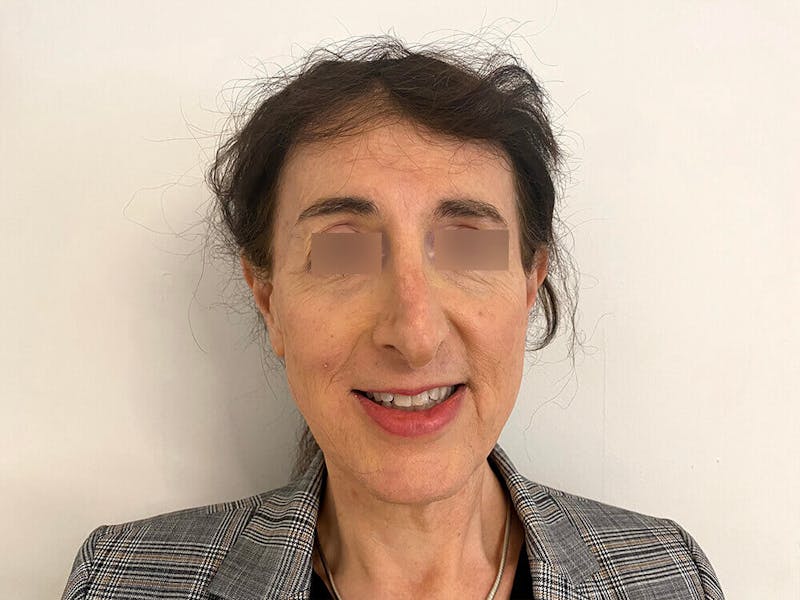 Case Studies Before & After Gallery - Patient 197338 - Image 3