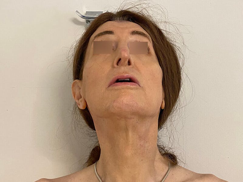 Case Studies Before & After Gallery - Patient 197338 - Image 6