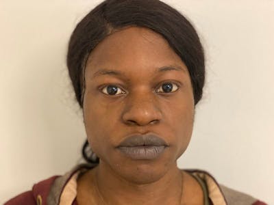 Case Studies Before & After Gallery - Patient 170033 - Image 1