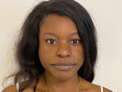 Case Studies Before & After Gallery - Patient 170033 - Image 2