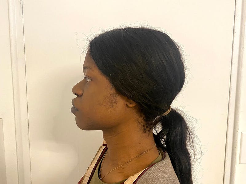 Case Studies Before & After Gallery - Patient 170033 - Image 3