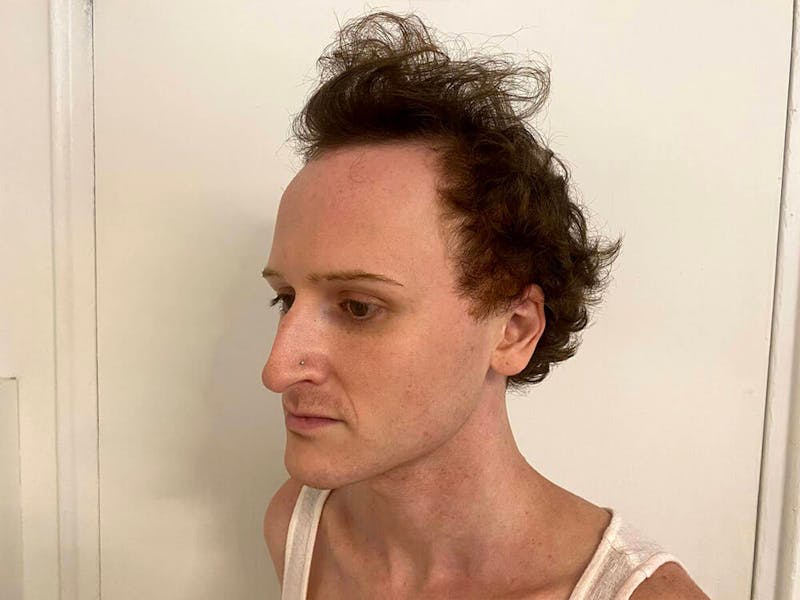 Case Studies Before & After Gallery - Patient 372925 - Image 1