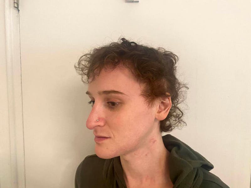 Case Studies Before & After Gallery - Patient 372925 - Image 2