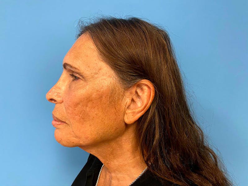 Case Studies Before & After Gallery - Patient 225102 - Image 1