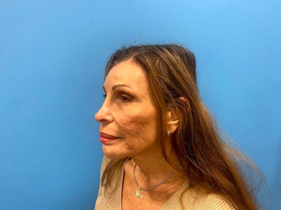 Case Studies Before & After Gallery - Patient 225102 - Image 2