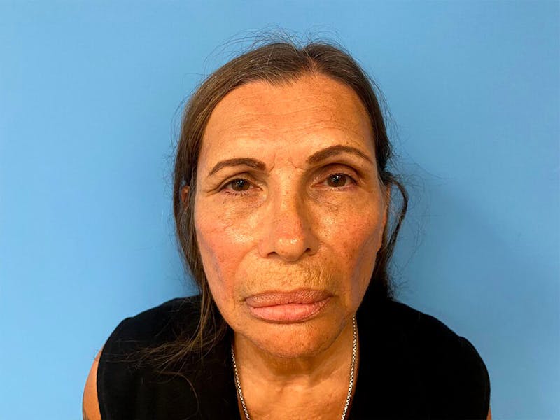 Case Studies Before & After Gallery - Patient 225102 - Image 3