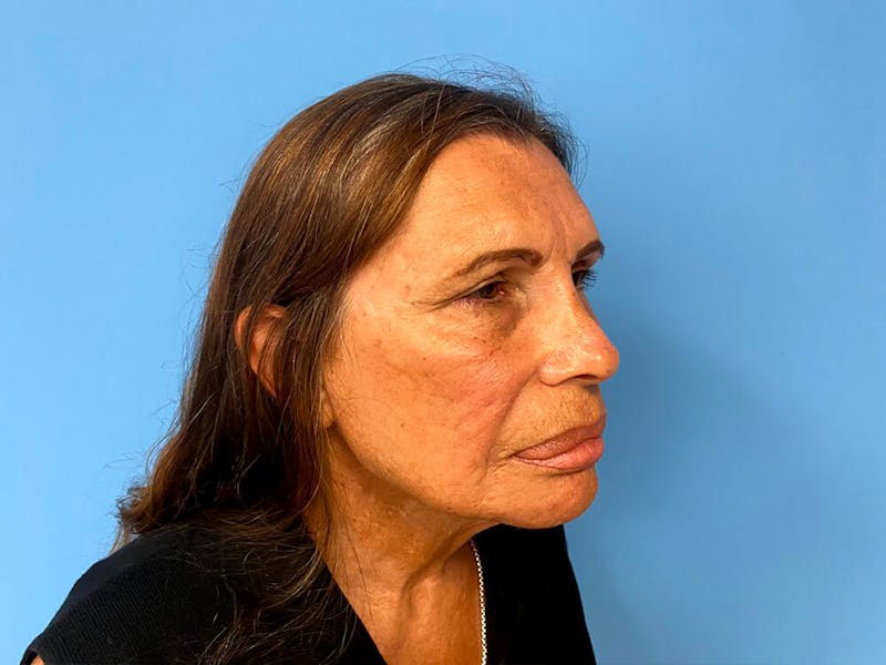 Case Studies Before & After Gallery - Patient 225102 - Image 5