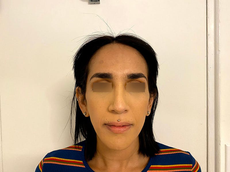 Case Studies Before & After Gallery - Patient 206183 - Image 2