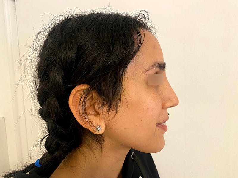 Case Studies Before & After Gallery - Patient 206183 - Image 5