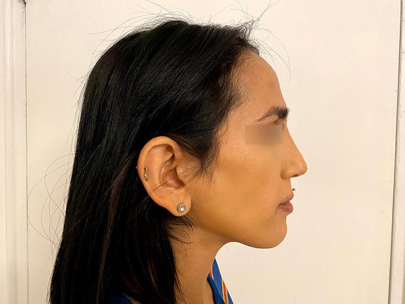 Case Studies Before & After Gallery - Patient 206183 - Image 6