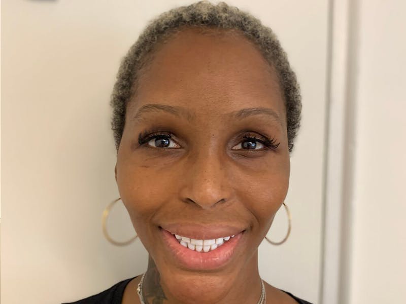 Case Studies Before & After Gallery - Patient 920765 - Image 1