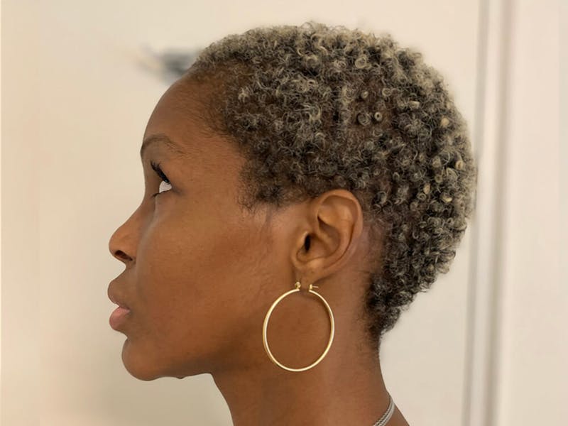 Case Studies Before & After Gallery - Patient 920765 - Image 3