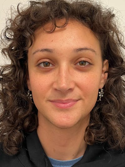 Genioplasty Before & After Gallery - Patient 184538 - Image 2