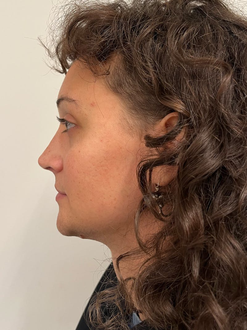 Genioplasty Before & After Gallery - Patient 184538 - Image 4