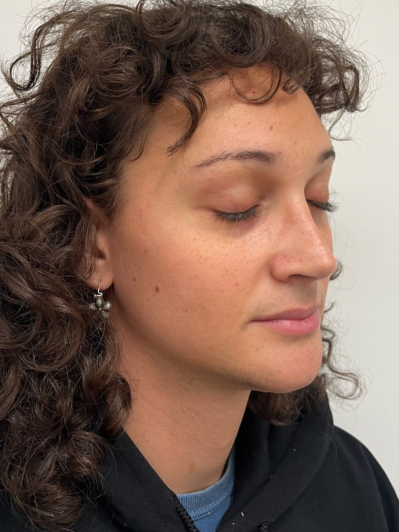 Genioplasty Before & After Gallery - Patient 184538 - Image 8