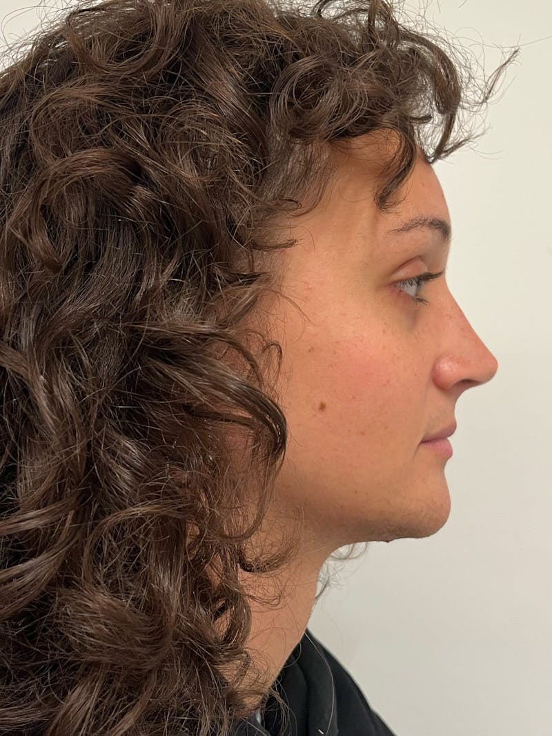 Genioplasty Before & After Gallery - Patient 184538 - Image 6