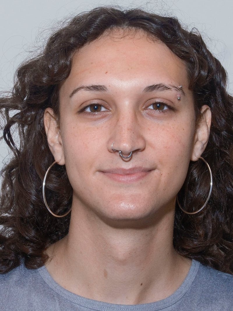 Genioplasty Before & After Gallery - Patient 184538 - Image 1