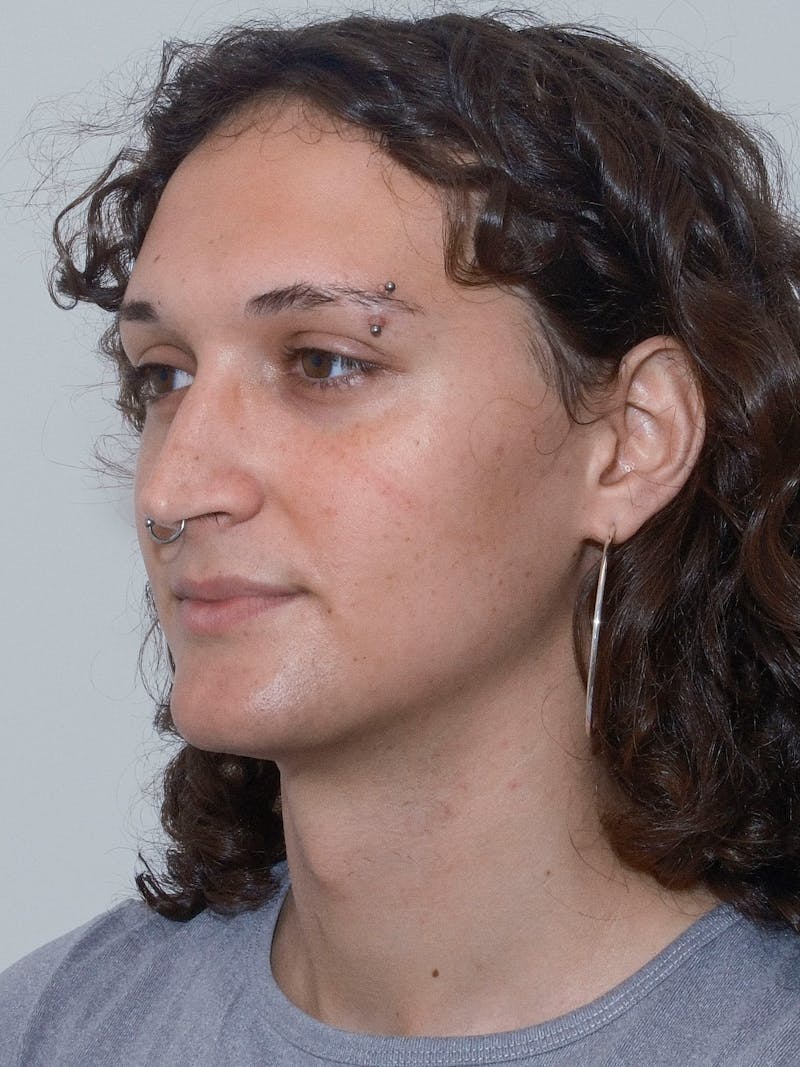 Genioplasty Before & After Gallery - Patient 184538 - Image 9