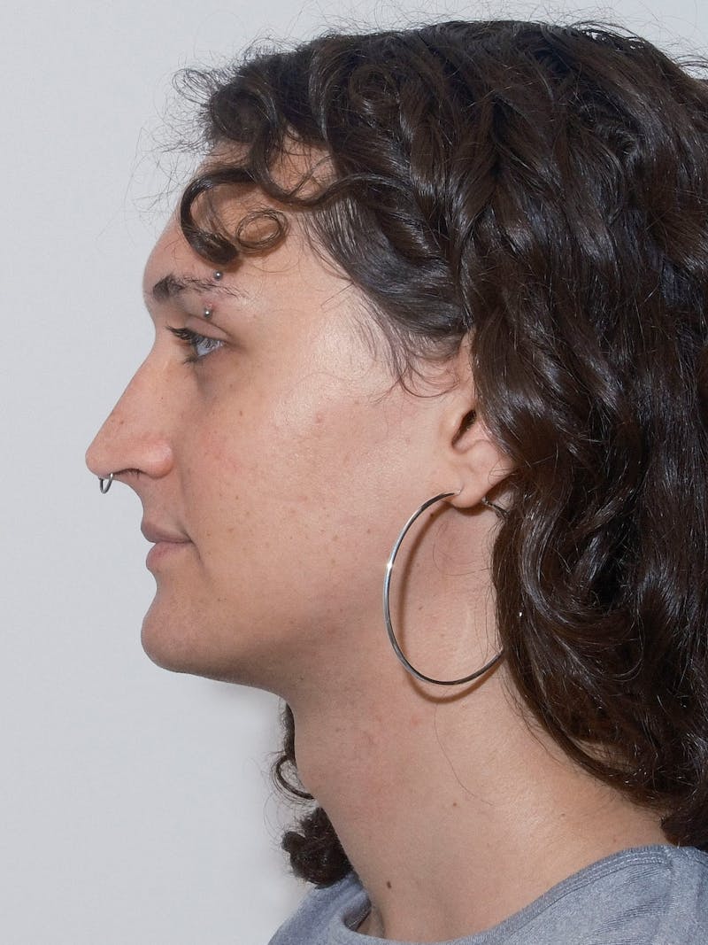 Genioplasty Before & After Gallery - Patient 184538 - Image 3