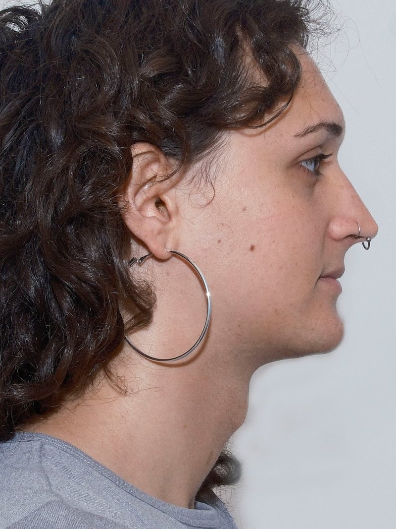 Genioplasty Before & After Gallery - Patient 184538 - Image 5