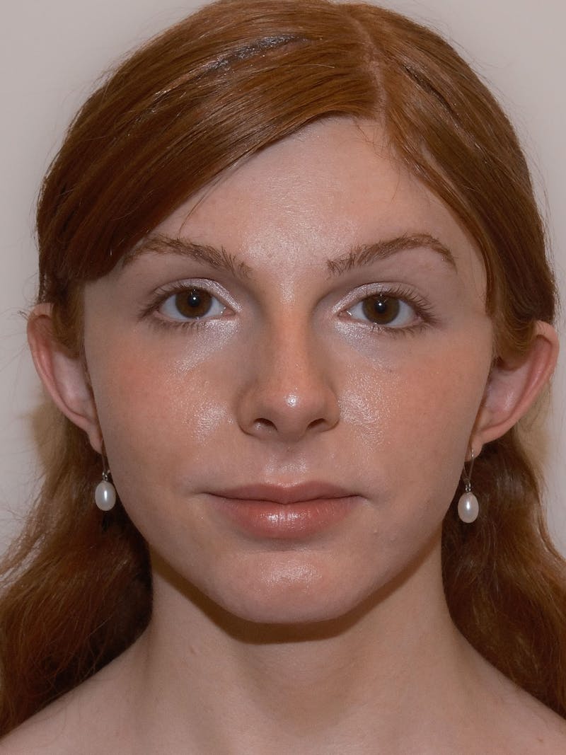Forehead Reduction Before & After Gallery - Patient 247188 - Image 2