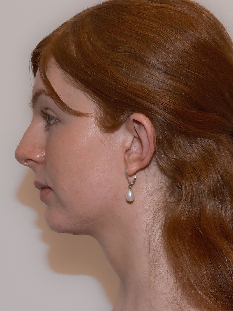 Forehead Reduction Before & After Gallery - Patient 247188 - Image 6