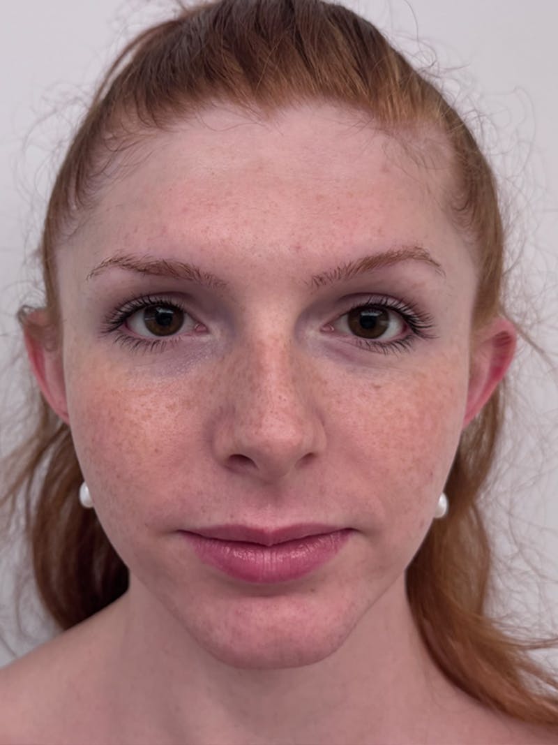 Forehead Reduction Before & After Gallery - Patient 247188 - Image 1