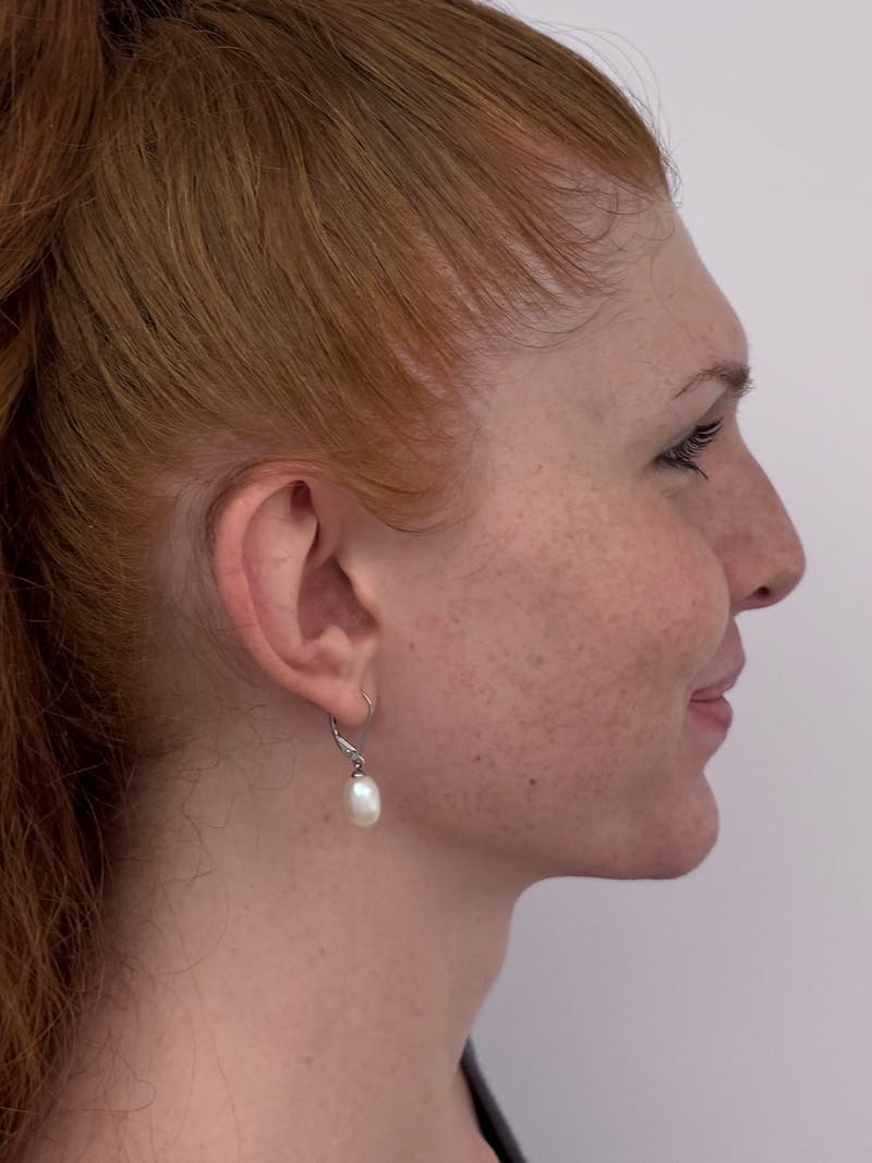 Forehead Reduction Before & After Gallery - Patient 247188 - Image 3