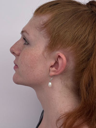 Brow Bone Reduction Before & After Gallery - Patient 381220 - Image 1