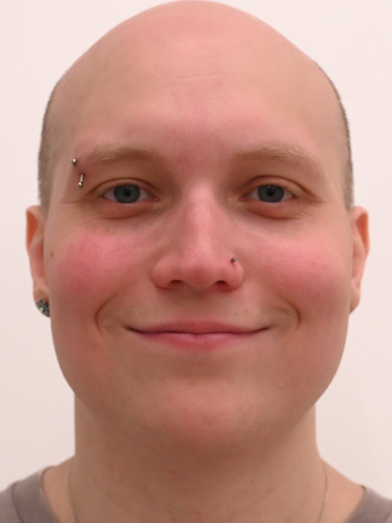 Rhinoplasty Before & After Gallery - Patient 521920 - Image 3