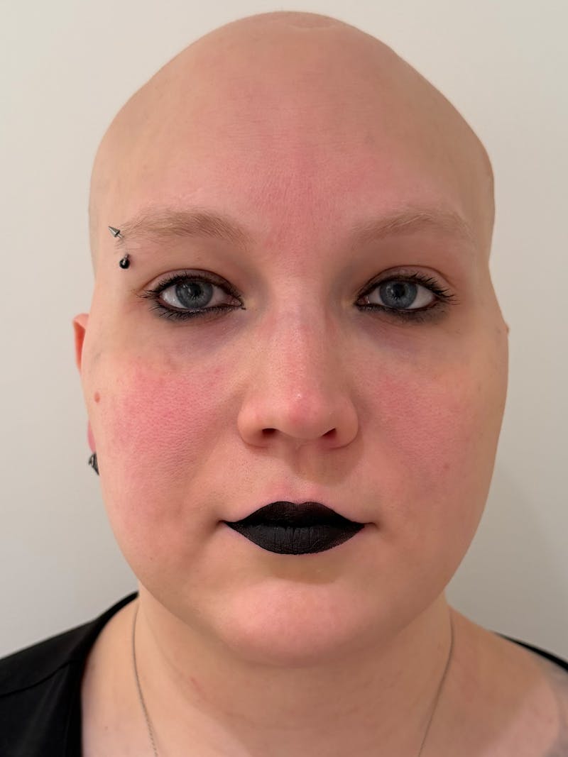 Rhinoplasty Before & After Gallery - Patient 521920 - Image 4