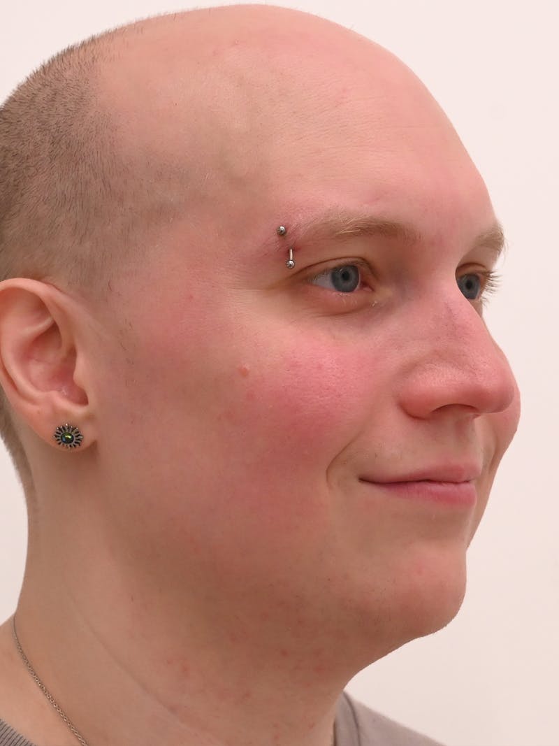 Rhinoplasty Before & After Gallery - Patient 521920 - Image 7