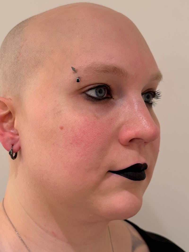 Rhinoplasty Before & After Gallery - Patient 521920 - Image 8