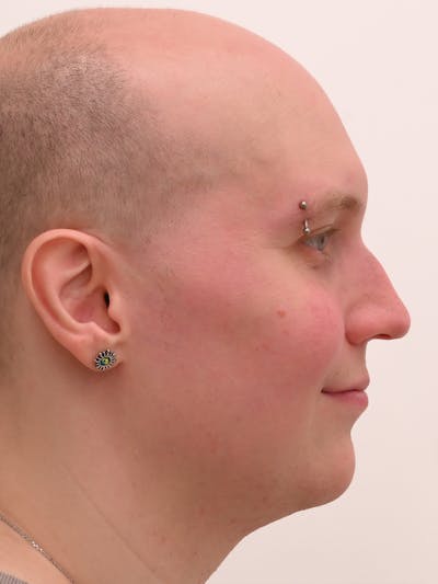 Rhinoplasty Before & After Gallery - Patient 521920 - Image 1