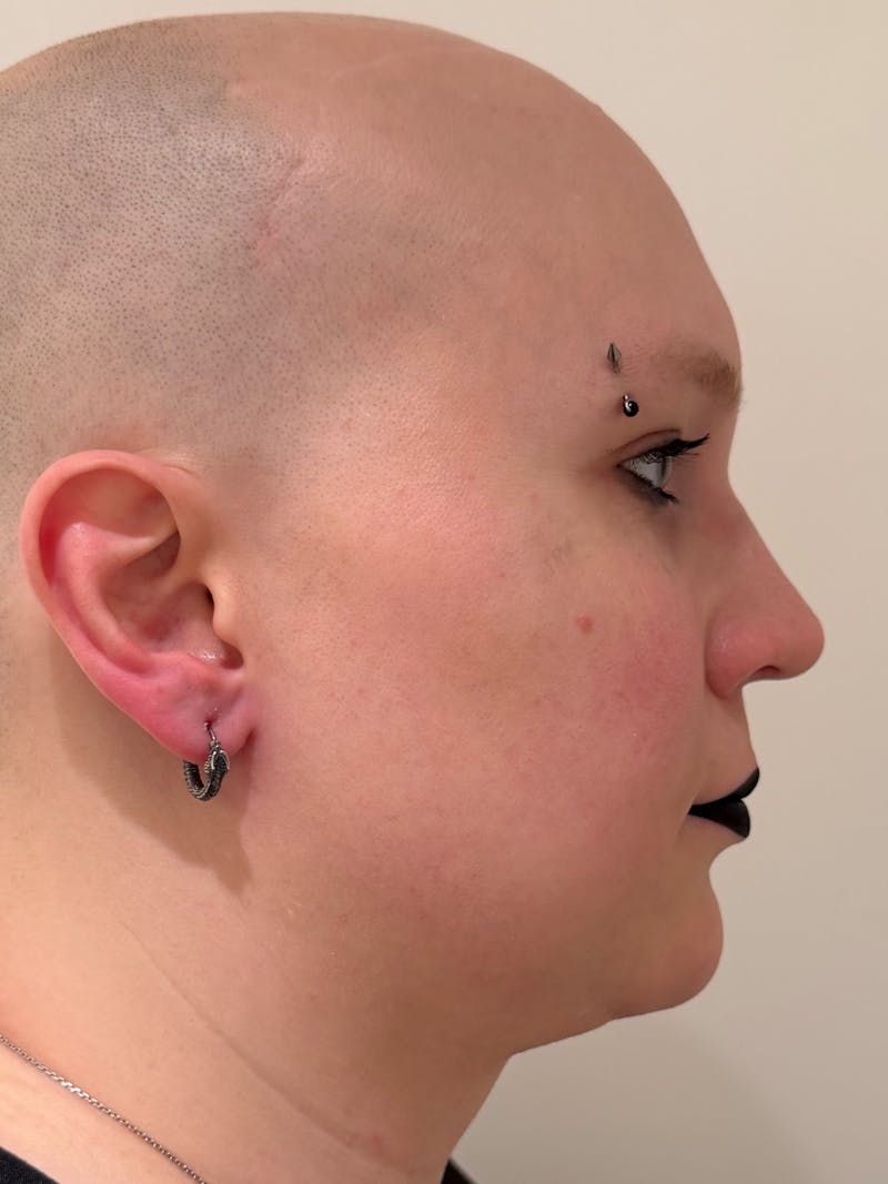 Rhinoplasty Before & After Gallery - Patient 521920 - Image 2